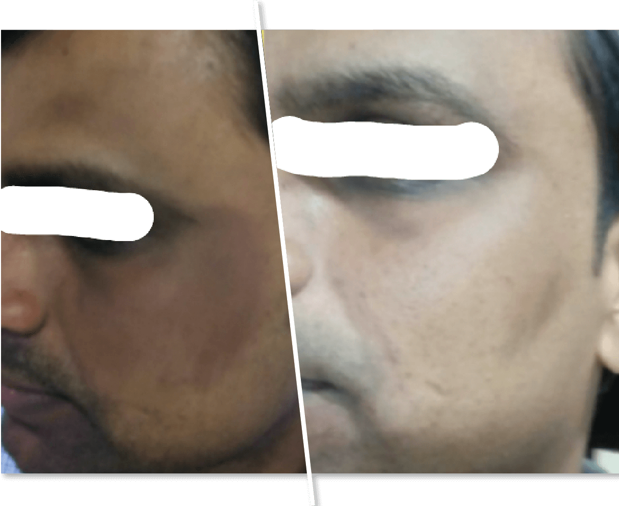 Men Before After Acne Scar Removal